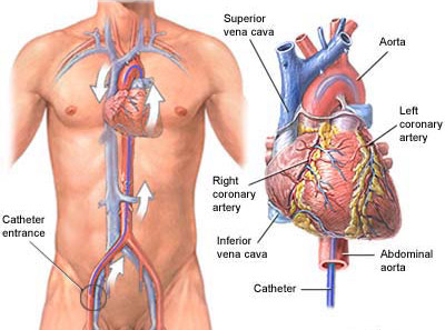 Cardiac Catheterization