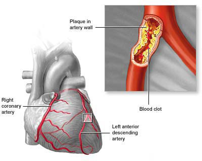 Atherosclerosis