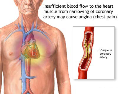 Stable angina