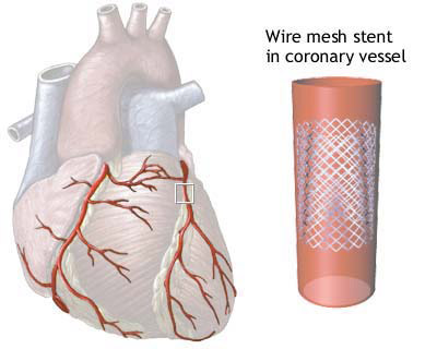 Stent